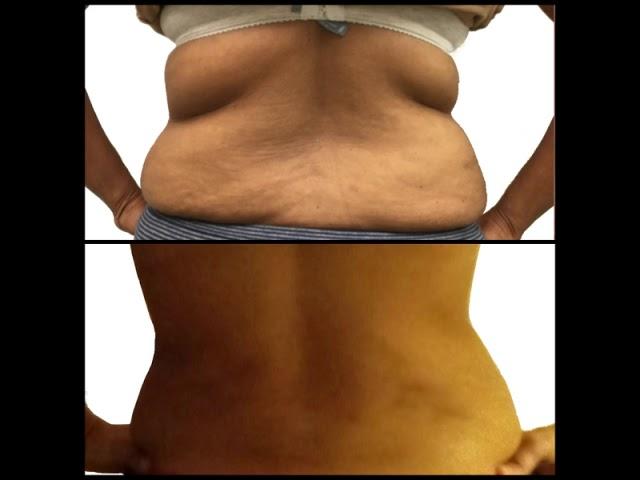 52 year old patient receives liposuction of the love handles (lower back)