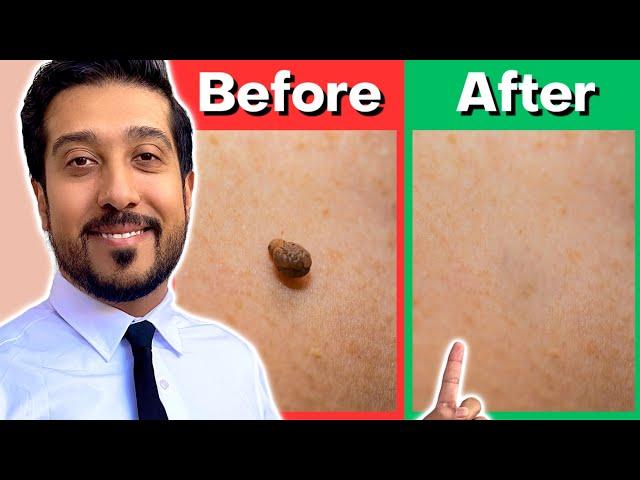 How to Remove Skin Tags Yourself AT HOME | Get Rid of Skin Tags NOW
