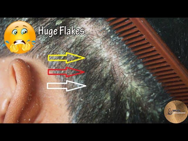 Satisfying Dandruff Scratching!!! Itchy Scalp Dandruff Removal At Home By Hair Comb#83