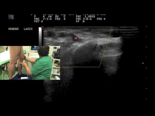 Outward contractive flow in a calf perforator and leg varicose veins