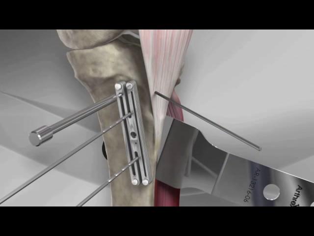 Tibial Tubercle Osteotomy with Arthrex® T3 AMZ System