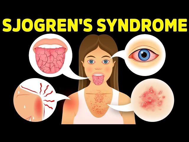 The Best Protocol for Sjogren's Syndrome