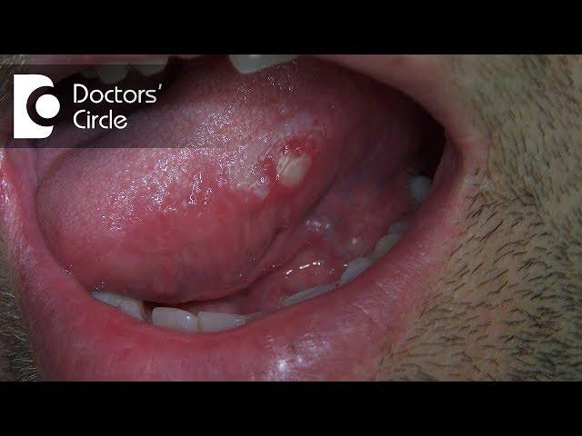 What are different circularlesions present on tongue? - Dr. Jayaprakash Ittigi