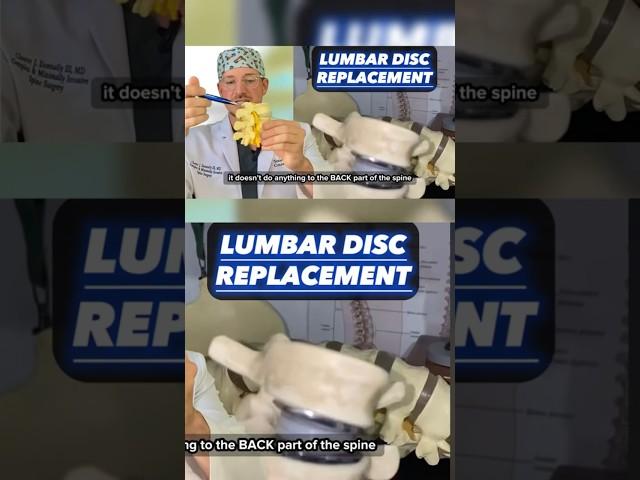 Quick update on disc replacements! (Texan Spine Surgeon Explains)