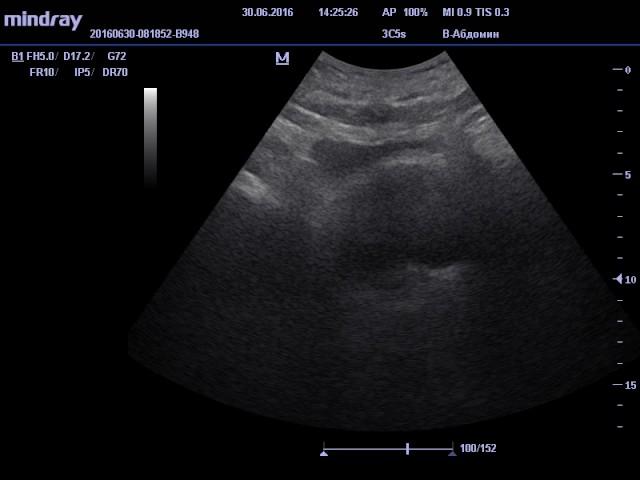 Трансабдоминальное исследование простаты ( Аденома простаты )