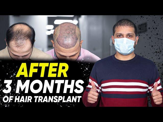 Hair Transplant in Ahmedabad | Best Results & Cost of Hair Transplant in Ahmedabad