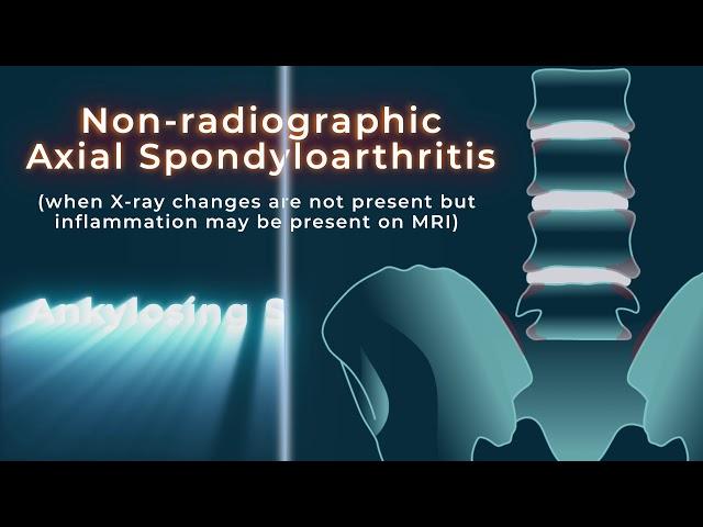 Welcome to the National Axial Spondyloarthrititis Society