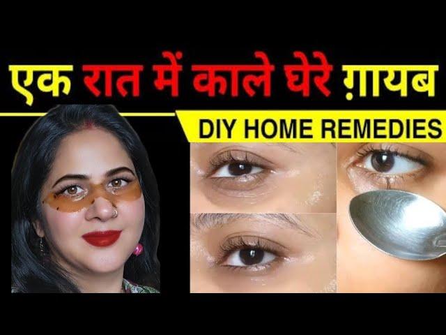 Dark Circles Under Eyes Home Remedy | Dark Circle Kaise Hataye| आंखों के काले घेरे कैसे ठीक करें