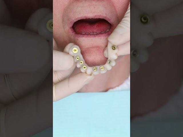 Dental implant’s All on 4 in Prague #shorts #dentist #dental #implant #veneers #short