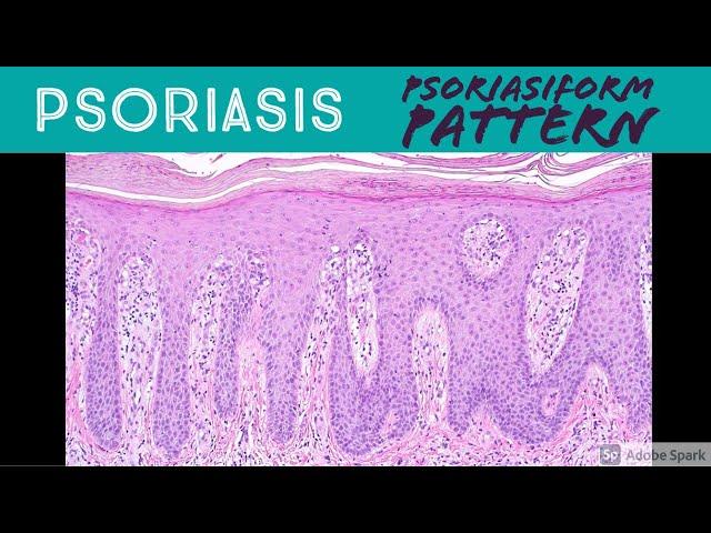 Psoriasis & Psoriasiform Dermatitis Pattern - Inflammatory Dermpath Basics for Dermatology Pathology