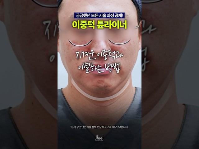 이중턱 튠라이너 시술과정 대공개