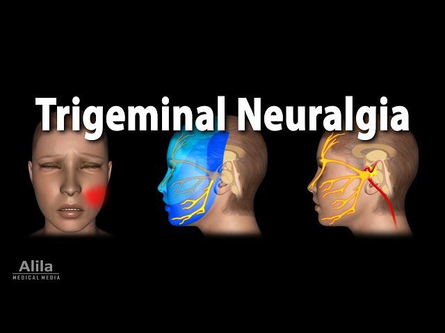 Trigeminal Neuralgia (Tic Douloureux), Animation