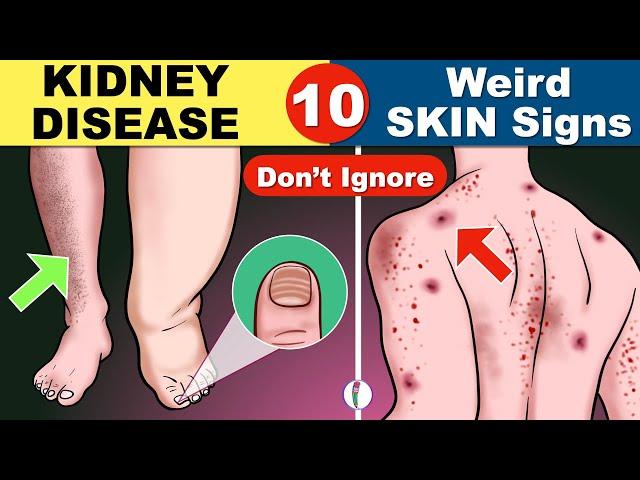 Skin signs of Kidney Disease | Chronic Kidney Disease | Kidney Failure Symptoms | CKD