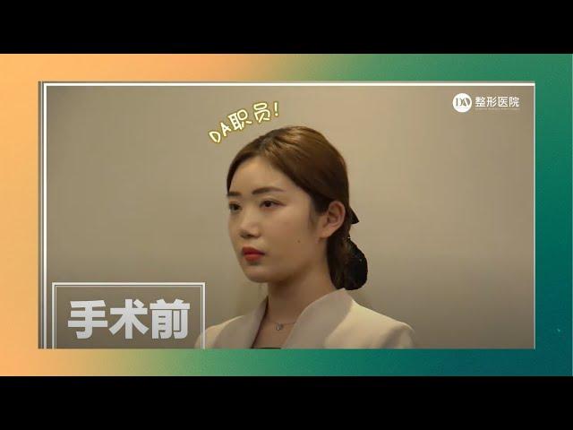 [韩国DA整形] DA前台小姐姐整容后记-第一弹！