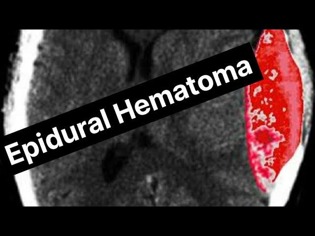 EpiduraHematoma \Dr Muhammad Ameer Hamza
