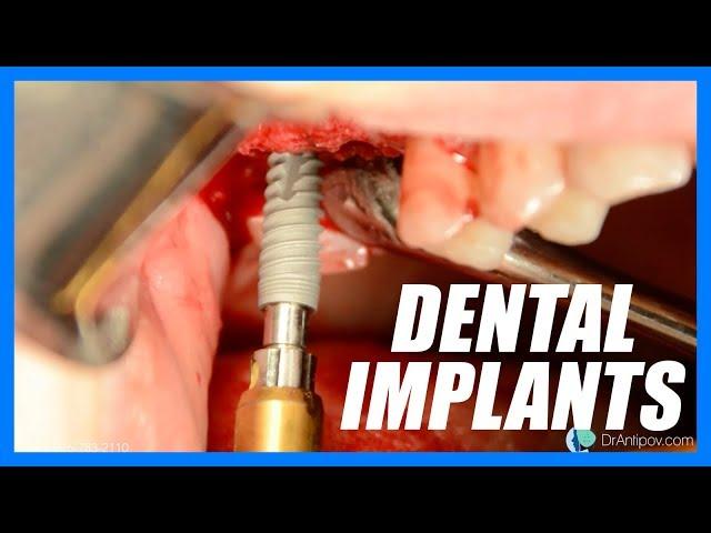 Dental Implants (SURGERY)