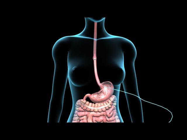 PEG | Feeding Tube | Nucleus Health