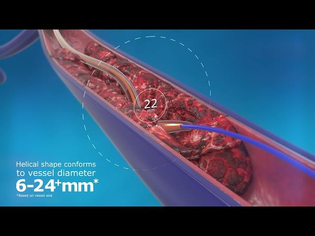 ClotHunter™ paired with ZelanteDVT™ Thrombectomy Catheter Enhancement