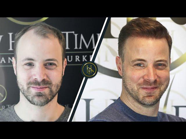 Hair Transplant Before and After | Hair Transplant Results