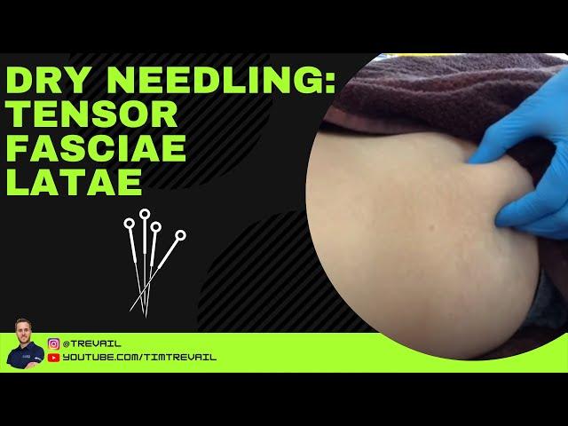 Dry Needling: Tensor Fascia Latae