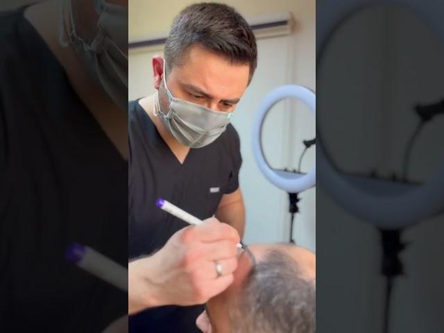 Saç ekimi nasıl yapılır? #sacekimi #hairtransplant #dolgu #istanbul Dermatolog Dr. Mustafa TÜMTÜRK