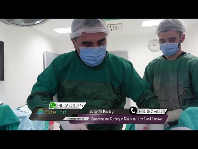 Gynecomastia Surgery in Slim Men - Live Gland Removal