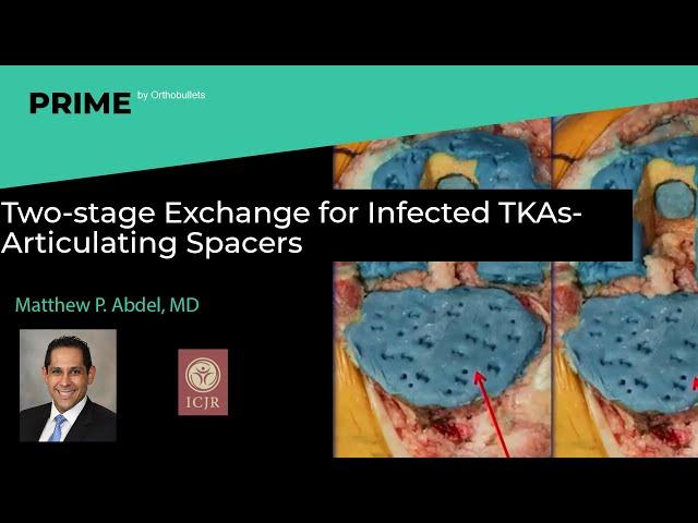 Two-stage Exchange for Infected TKAs- Articulating Spacers - Matthew P. Abdel, MD