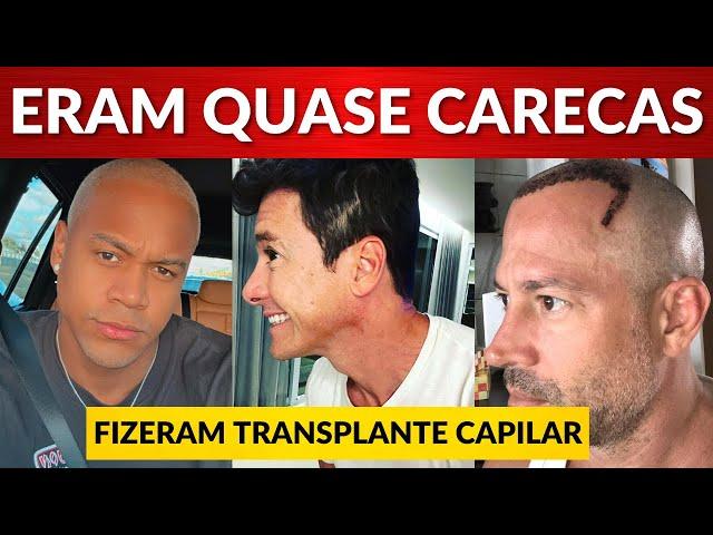 Famosos que já fizeram transplante capilar e você nem imaginava