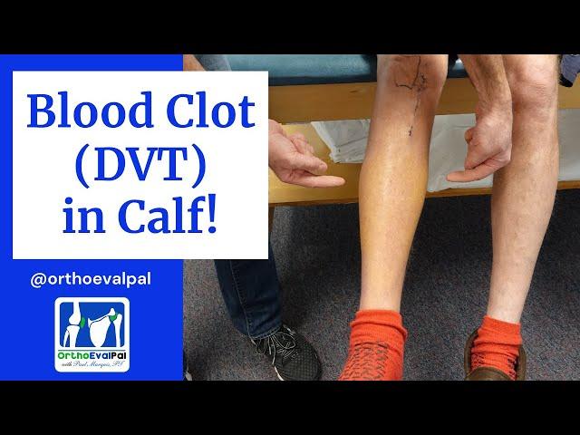 Blood Clot (DVT) in  the Calf! Actual Patient Presentation