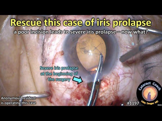 CataractCoach 1197: rescue this case of iris prolapse during cataract surgery