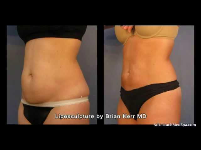 Liposuction Before and After Abdomen Area, Part 1 | Silk Touch Medspa Boise