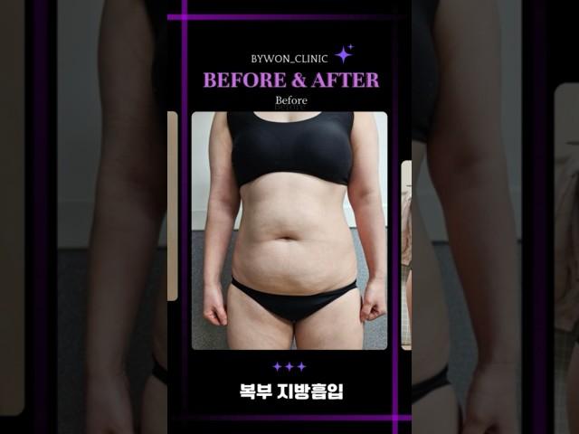 복부 지방흡입 후기 #복부지흡