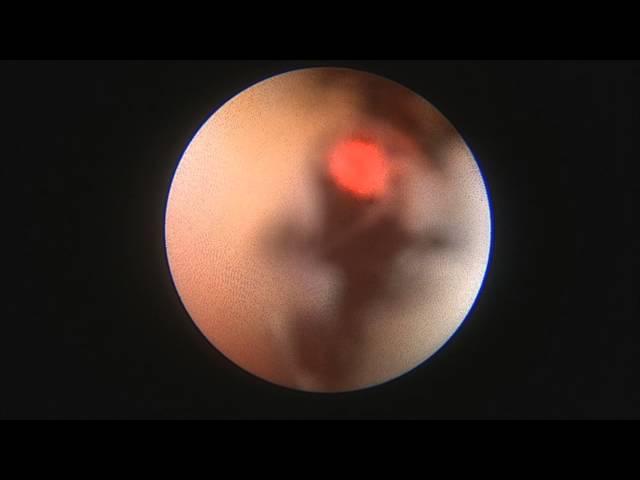 Laser urethrotomy. Dr. Farid Gadimaliyev, Customs Hospital, Baku, Azerbaijan