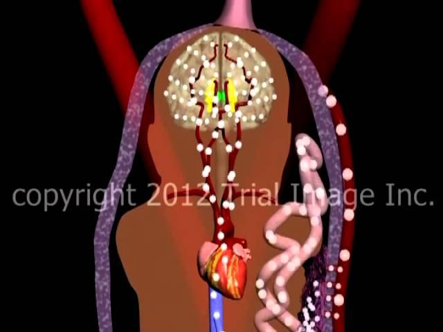 Hypoxic Ischemic Encephalopathy (HIE)  video - Animation by Cal Shipley, M.D.