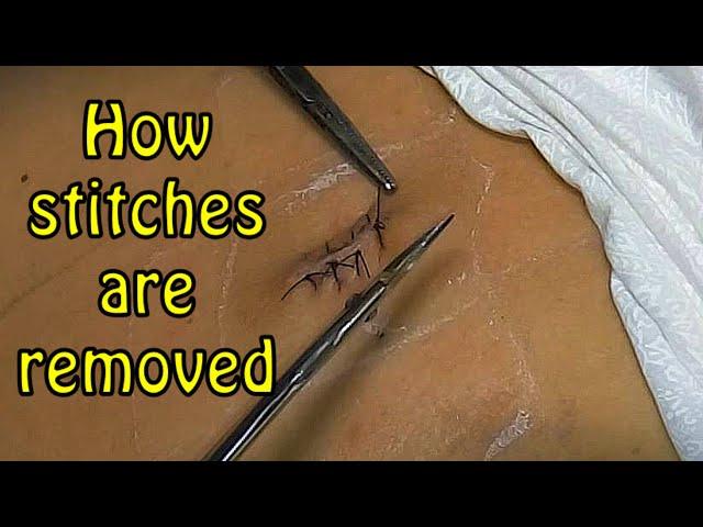 How stitches are removed #how