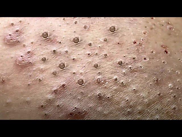 Make your Acne Treatment Huong Da Nang#494 | acne 2022