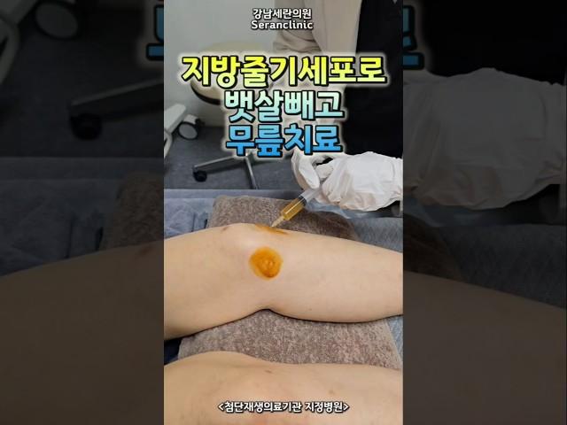 #무릎퇴행성관절염 #무릎통증 #연골손상  #줄기세포무릎주사
