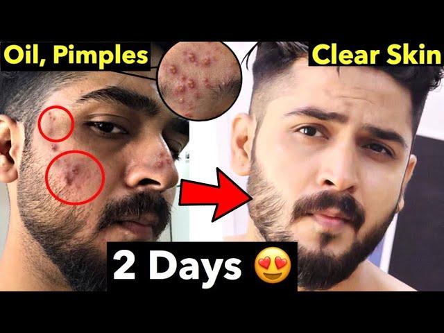 10 Pimple Mistakes | How to Remove Pimples From Face | Remove Acne Naturally