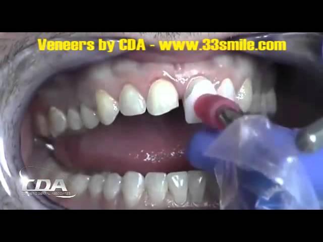 A Video of Prepless Dental Veneers Procedure at Cosmetic Dental Associates San Antonio, TX