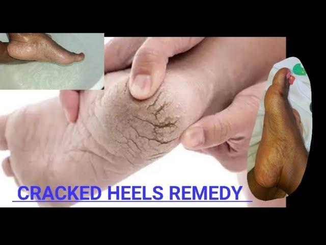 BEST FOOT SCRUBBING AT HOME TO AVOID CRACKED HEELS#diypedicureathome #crackedheelshomeremedy