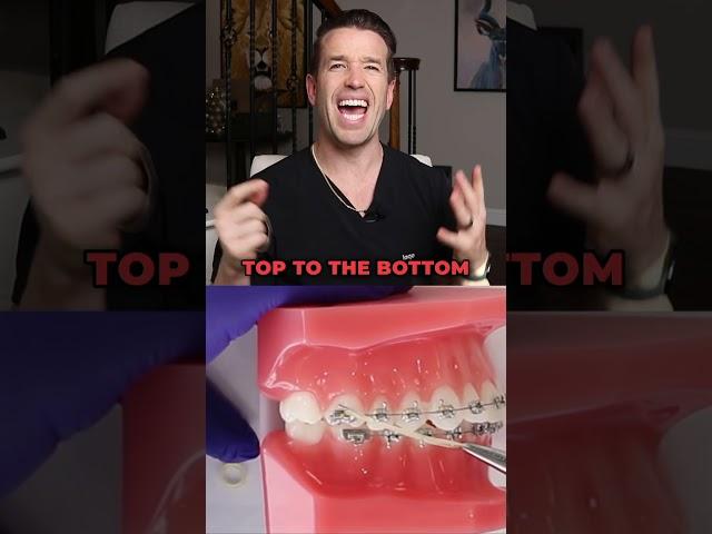 Braces Rubber Bands You Need to Know