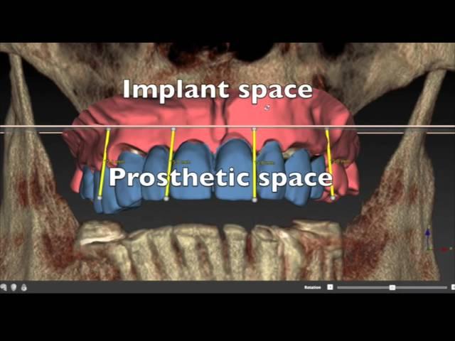 All on 4 treatment concept