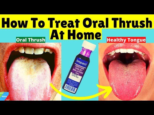 How To Treat Oral Thrush At Home | How to Treat Candida at Home