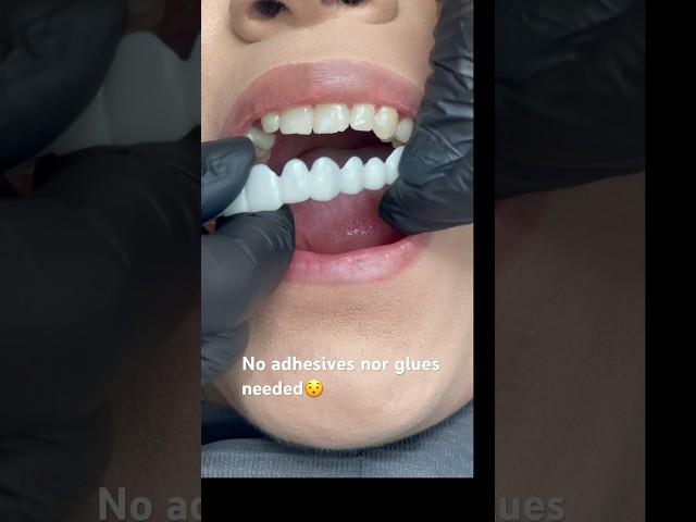 No other cosmetic appliance does this ! Snap-on Smile ️