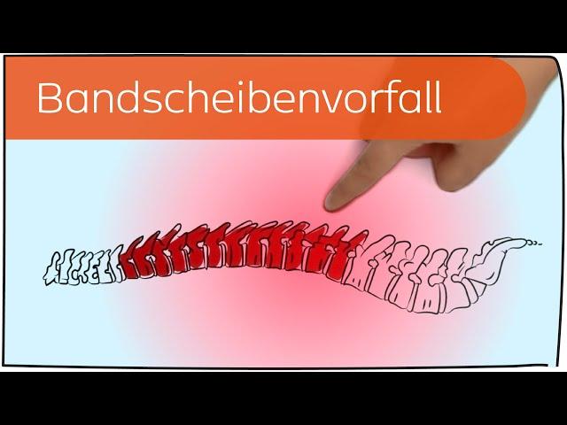 Bandscheibenvorfall in 3 Minuten erklärt