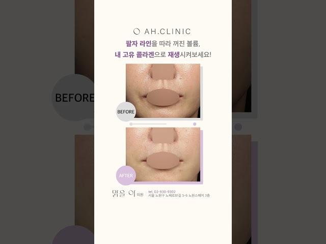 입가주름, 내 고유 콜라겐으로 재생시켜보세요!