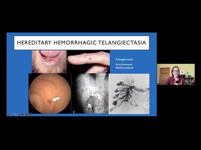 Four Things the World Should Know About Hereditary Hemorrhagic Telangiectasia (HHT)