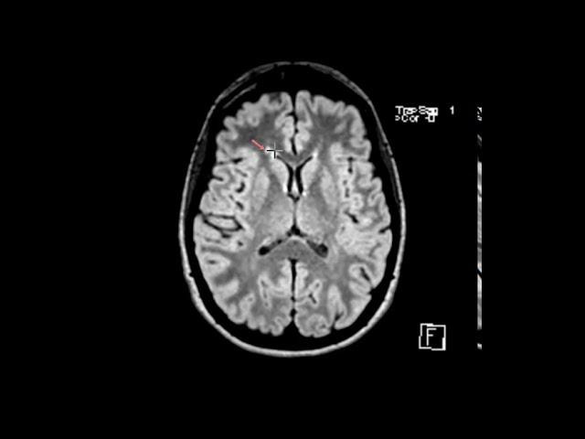 MS white matter lesions | First Look MRI
