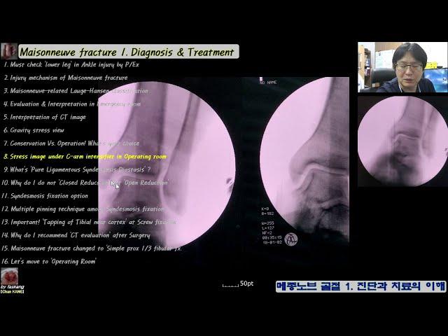487.(의사용. Maisonneuve fx. 1:5~9) Diagnosis & Treatment. 메종노브 골절: 진단과 치료 [강찬.정형외과.충남대병원.Chan KANG]
