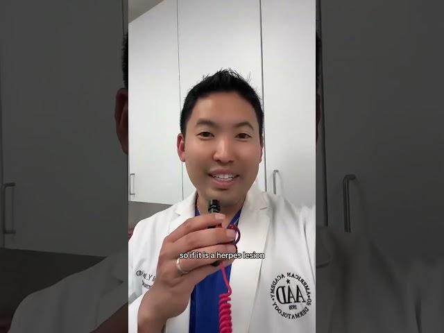 Dermatologist Explains: Cold sores/Herpes Simplex Virus